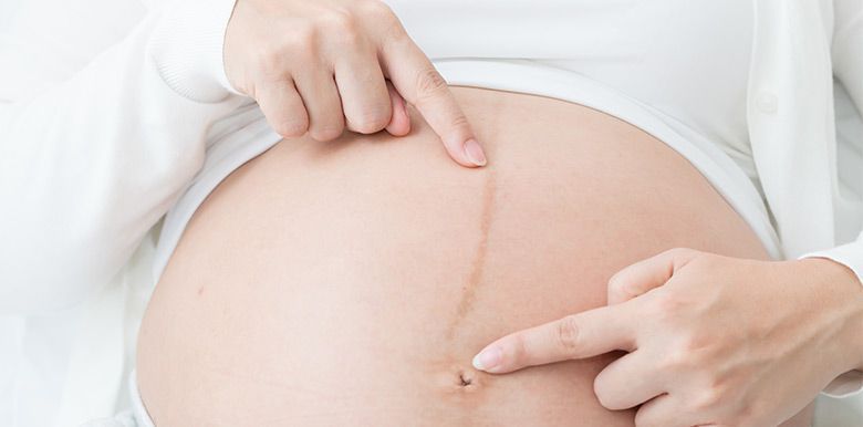 La ligne brune sur le ventre pendant la grossesse